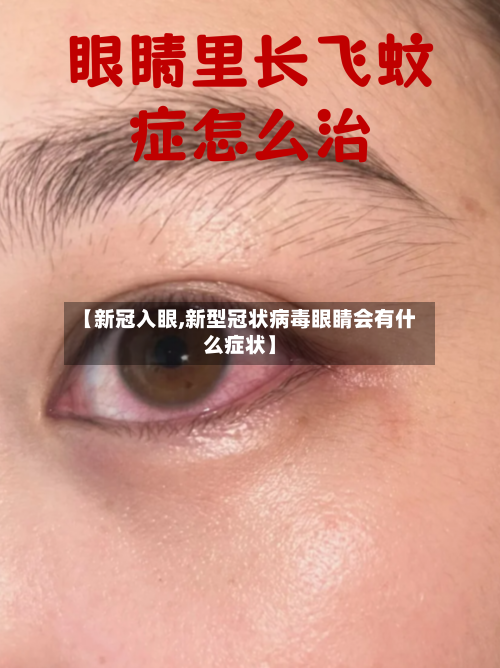 【新冠入眼,新型冠状病毒眼睛会有什么症状】-第3张图片