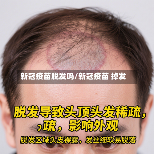 新冠疫苗脱发吗/新冠疫苗 掉发-第2张图片